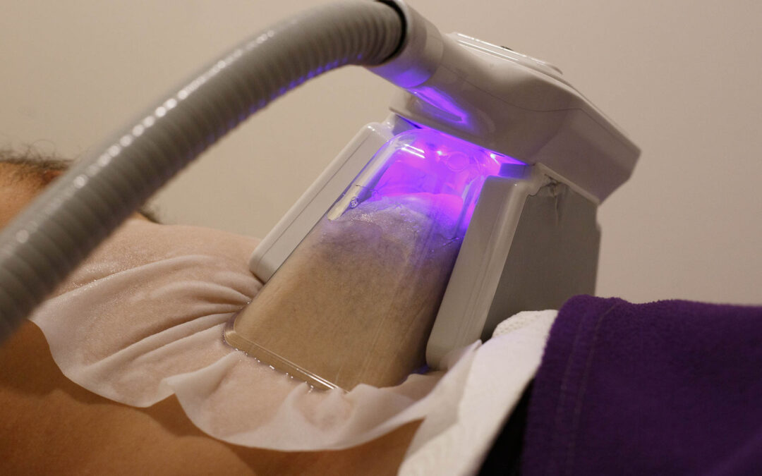 Cryothérapie ventre : une solution pour perdre du gras abdominal ?