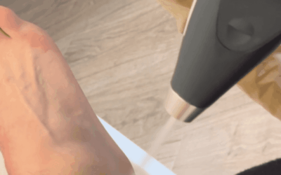 Entorse : froid ou chaud pour soulager la douleur ?