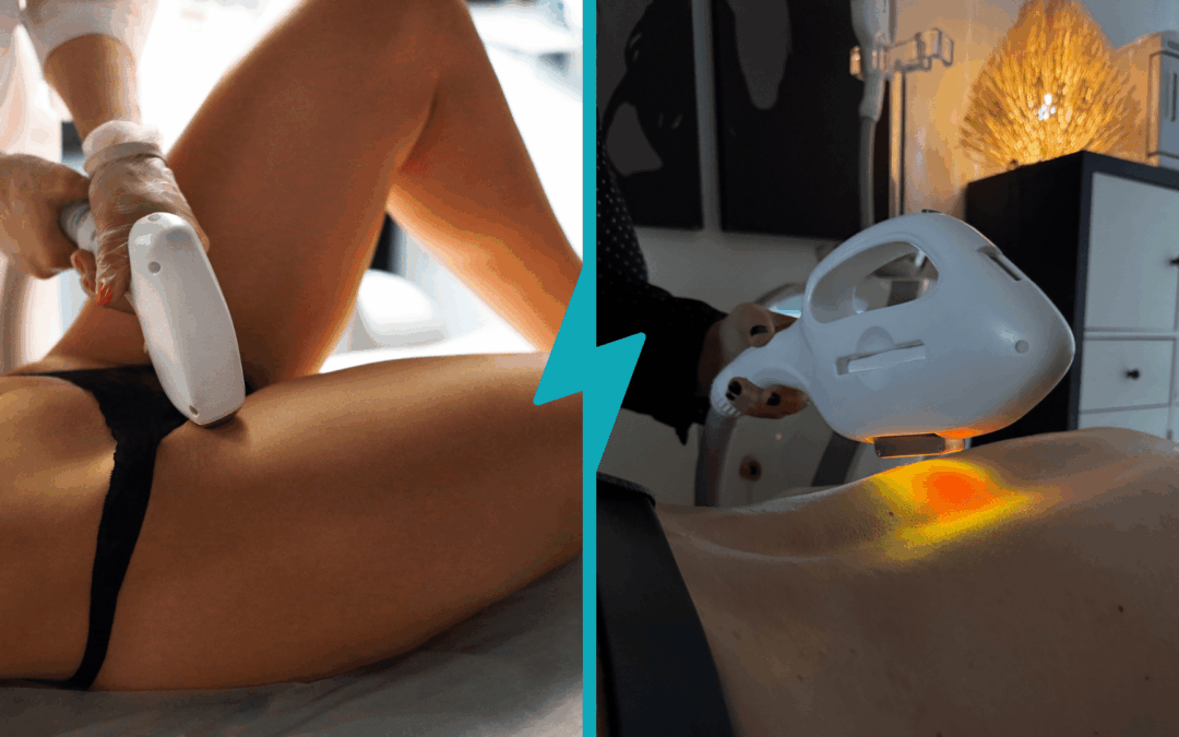 Épilation lumière pulsée ou laser : les méthodes d’épilation définitives